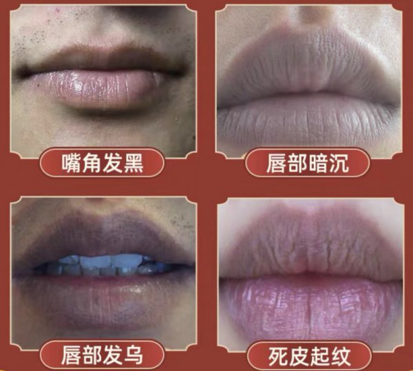 嘴唇颜色深怎么改善