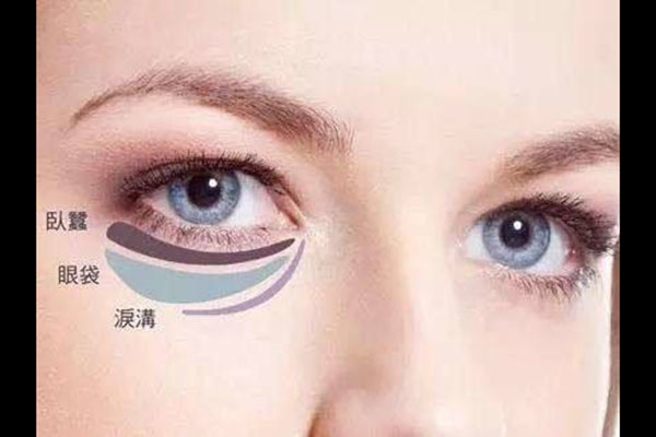 泪沟是天生的吗
