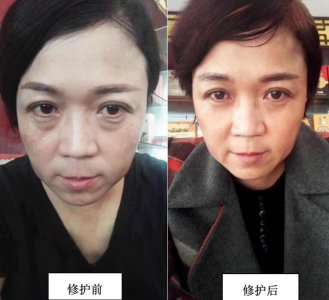 有眼袋了怎么办啊 怎么消除呢 有哪些办法