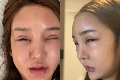 网红桃花宝宝整容上瘾 嘴歪眼斜吓死人