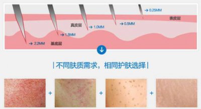 微针是什么 微针是什么美容项目多少钱