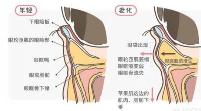 眼袋怎么样才能消除 眼袋怎么消除简单方法有哪些