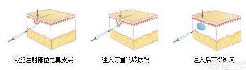 木偶纹怎么形成的