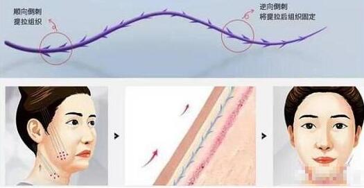 木偶纹怎么形成的