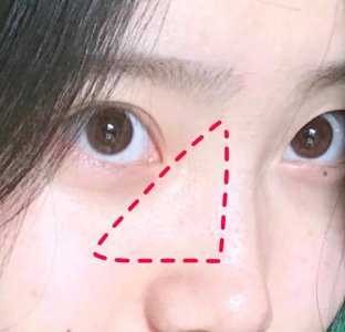 眼睛下方长很多脂肪粒怎么办 眼睛下方有很多小脂肪粒怎么办？