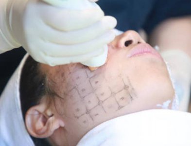 热玛吉的原理和功效维持多久 热玛吉效果怎么样