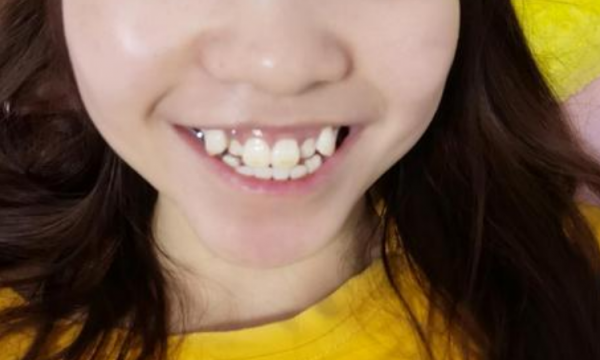 为什么女孩子有虎牙不能娶