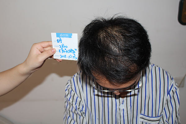 脱发是什么原因引起的