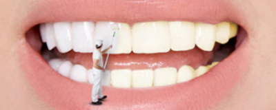 美白牙贴有用吗 牙齿怎么变黄的