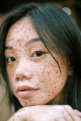 快速祛痘的妙招