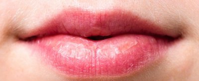 嘴唇干裂是什么原因 嘴唇干燥怎么办