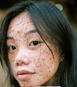 痘痘肌禁用护肤品的成分 温和有效的天然愈痘成分