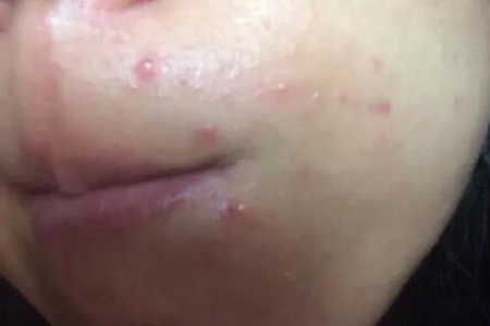 嘴角喜欢长痘痘是什么原因