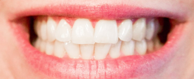 美白牙齿的方法 牙齿变黄的原因