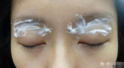 割双眼皮术前术后注意事项 割双眼皮手术前后需要注意什么