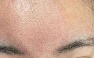 额头毛孔粗大怎么改善 如何改善皮肤粗糙毛孔大没有光泽