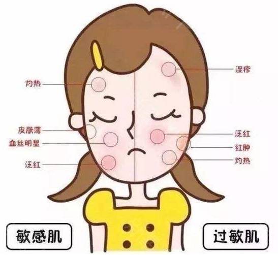红敏肌自己怎么改善