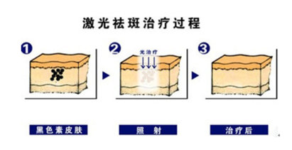 做了激光祛斑后多久可以洗脸