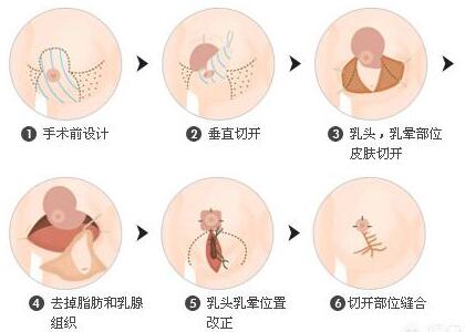 如何做缩胸手术的方法