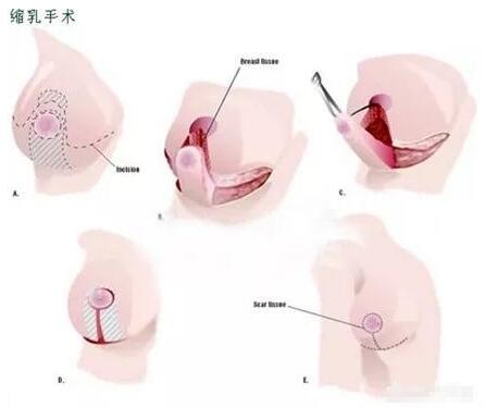 如何做缩胸手术的方法