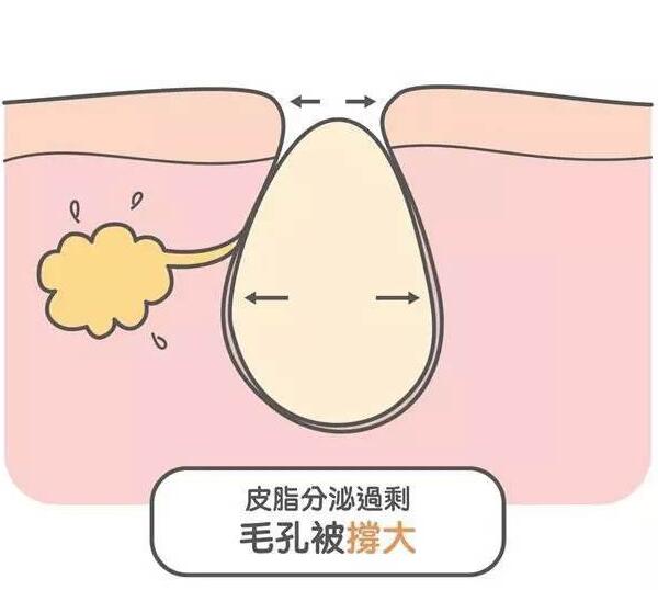 改善脸部毛孔粗大方法