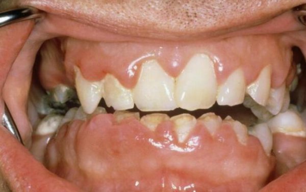 牙缝变大是什么原因造成的
