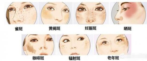 脸上有斑怎样才能祛斑？